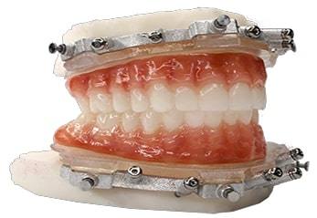 Chrome™ Full Arch Guided Smile