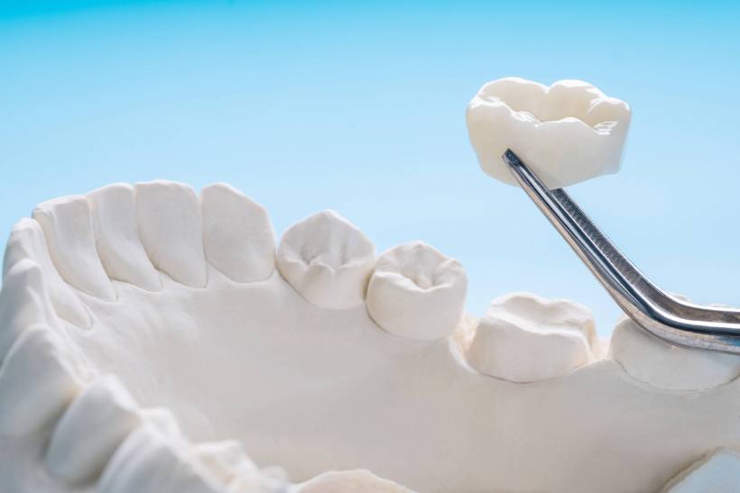 e.max® Crowns & Veneers