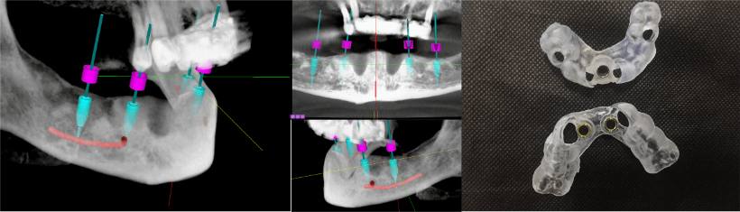Dental Implant Surgical Guides