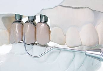 Zirconia Crowns & Bridges