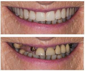 Before and after: Implant crown & bridge restoration