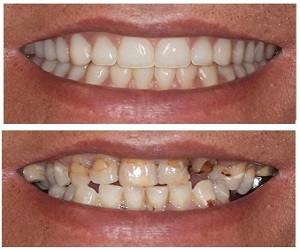 Before and after: Smile makeover