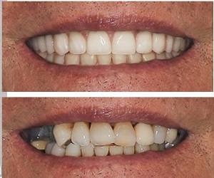 Before and after: Full-arch restorative case