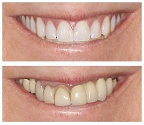 Before and after: Crown & bridge work
